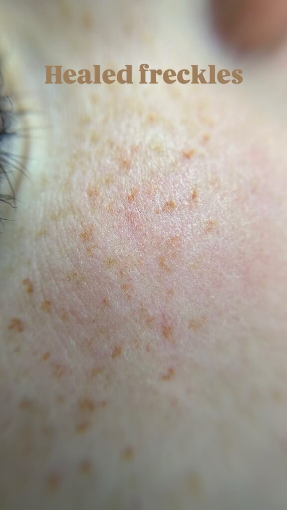 Freckles First Session