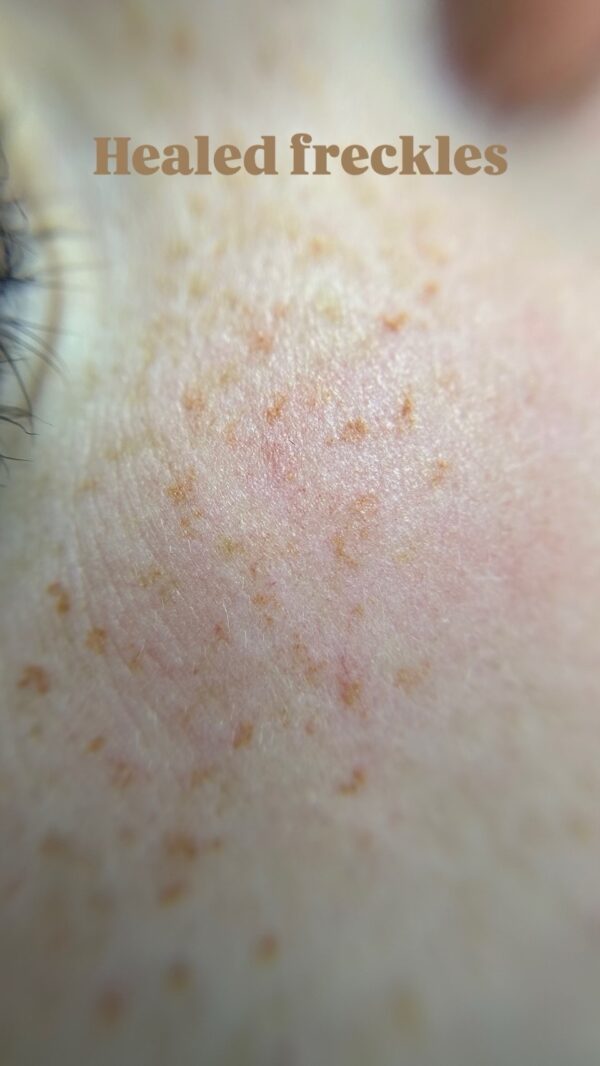 Freckles First Session