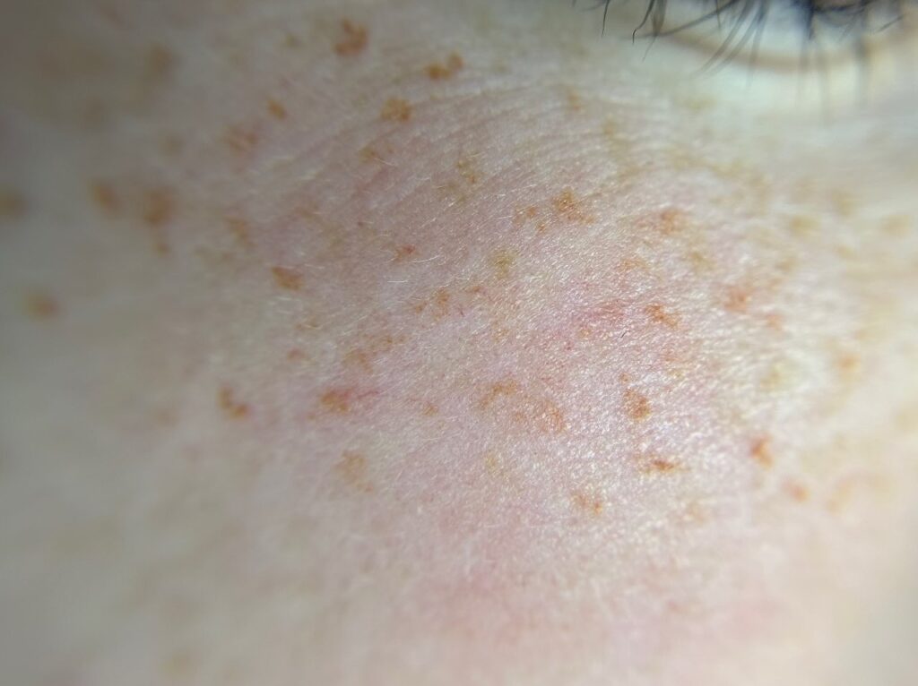 Freckle Yearly Refresher — image 1