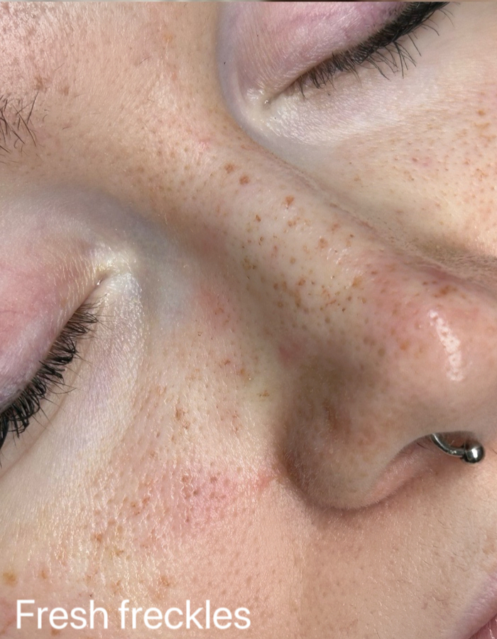 Freckles - Image 1
