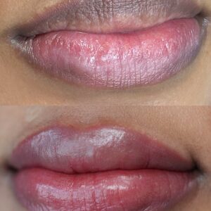Dark Lip Neutralization First Session - Image 5