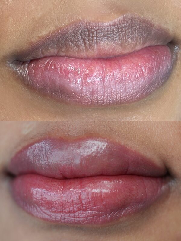 Dark Lip Neutralization First Session