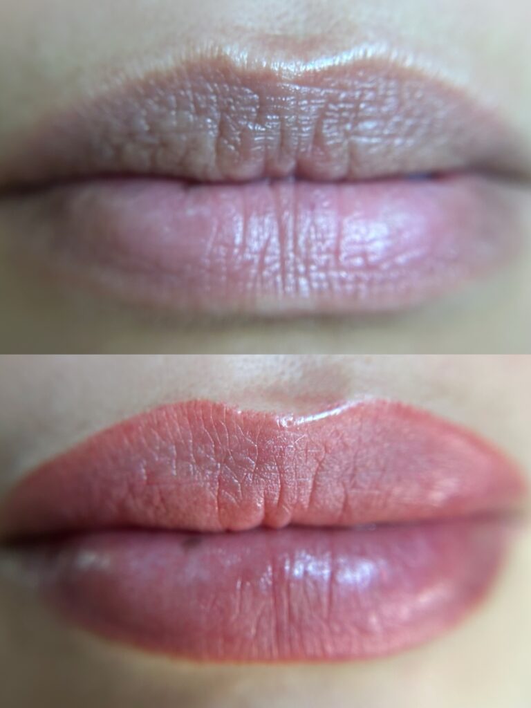 Dark Lip Neutralization First Session