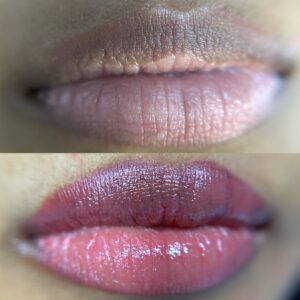 Dark Lip Neutralization First Session - Image 3