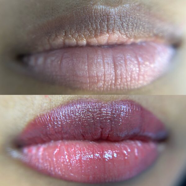 Dark Lip Neutralization First Session