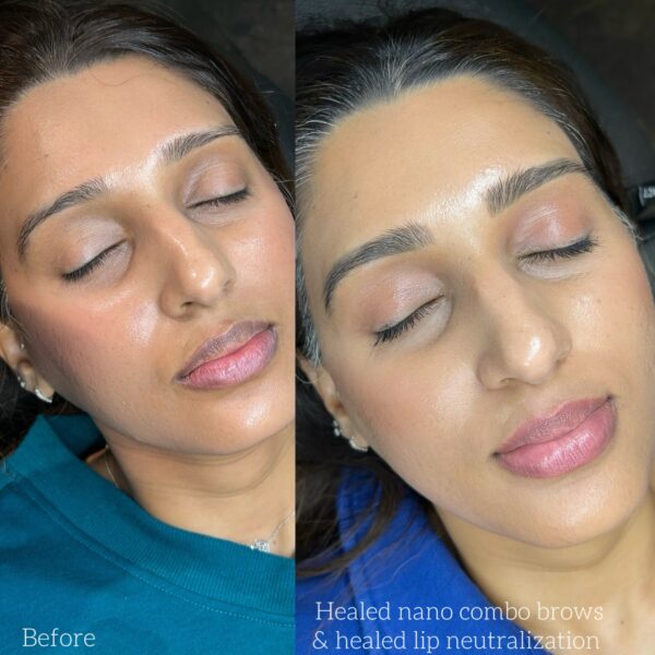 Dark Lip Neutralization First Session