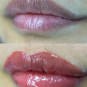 Dark Lip Neutralization First Session - Image 4