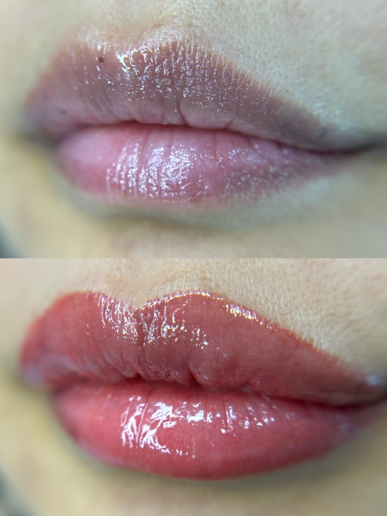 Dark Lip Neutralization First Session