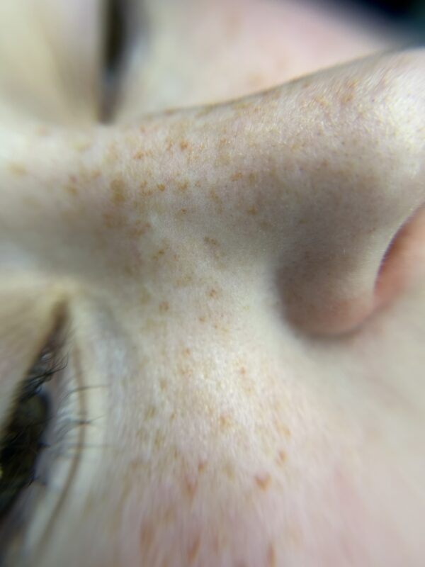 Freckles First Session