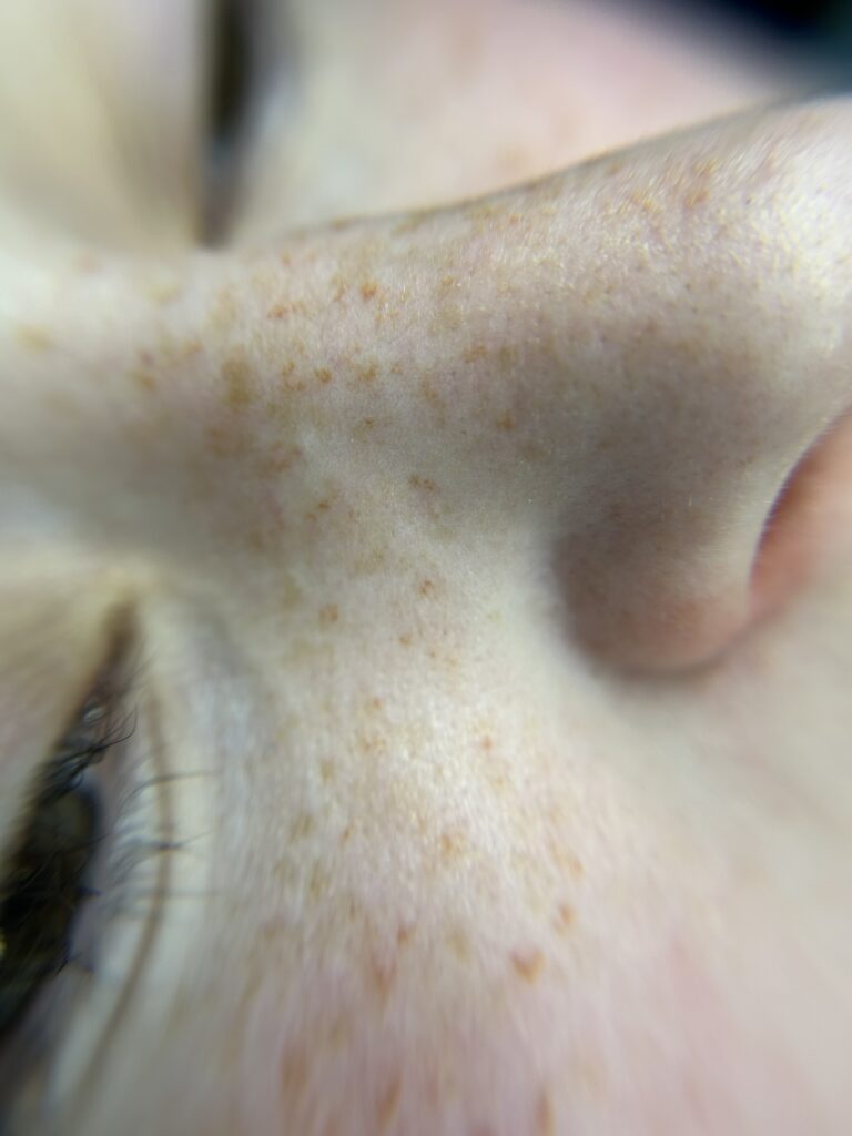 Freckles First Session