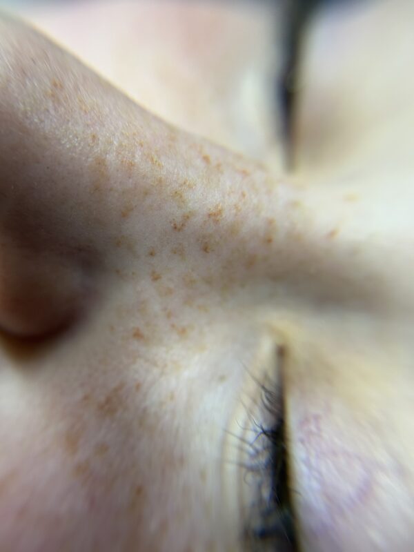 Freckles First Session