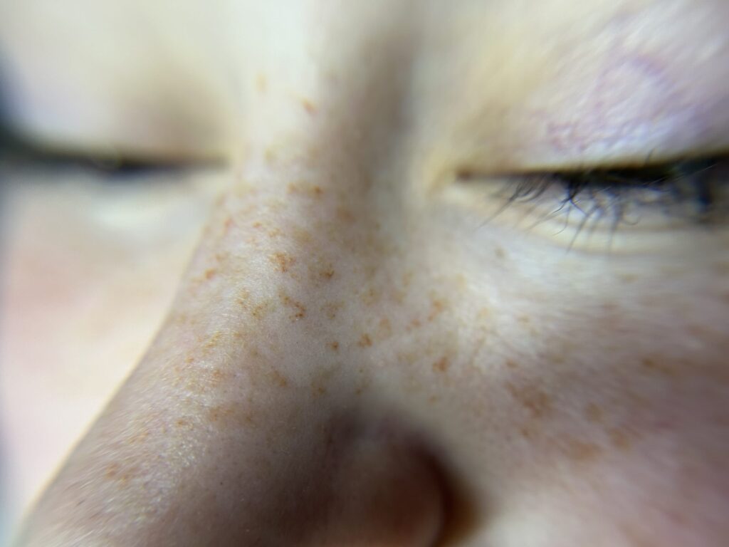 Freckles First Session