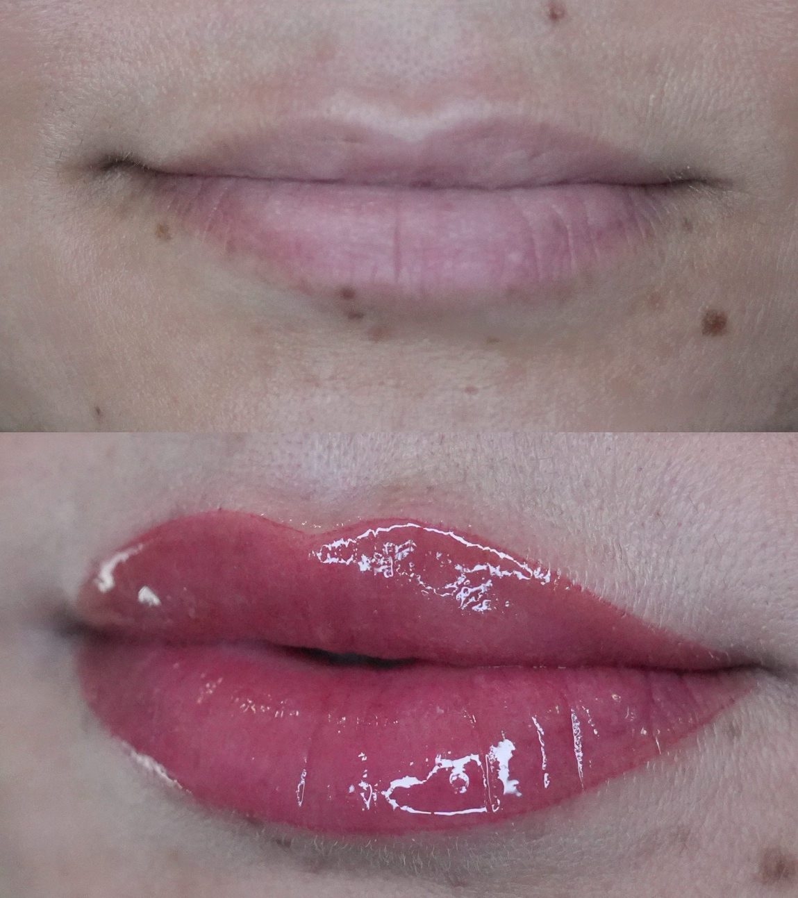 Dark Lip Neutralization First Session